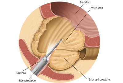 Εικ. 4: Το ρεζεκτοσκόπιο αφαιρεί μέρος του προστάτη Image