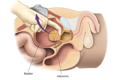 Εικ.5: Ανοιχτή Προστατεκτομή Image