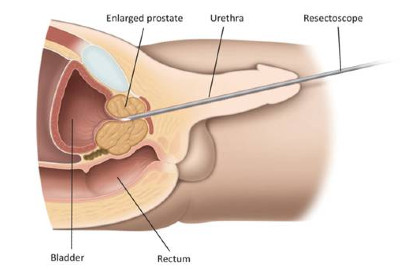 Εικ. 6: Ένα ρεζεκτοσκόπιο εισάγεται μέσω της ουρήθρας Image