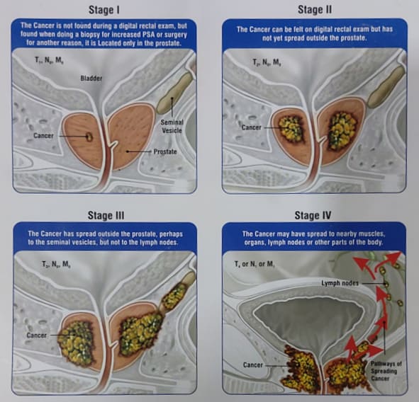 Εικ. 2: Τα Στάδια του Καρκίνου του Προστάτη Image