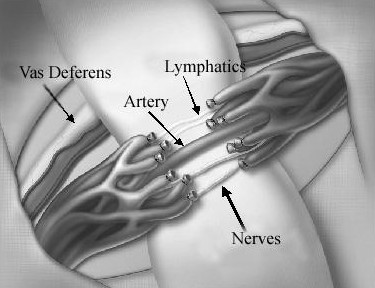 Εικ. 2: Απολίνωση των σπερματικών φλεβών Image