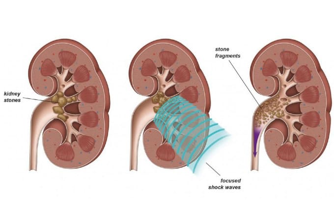 Εικ. 4: Εστιασμένα κρουστικά κύματα κατακερματίζουν λίθους σε μικρότερα θραύσματα Image