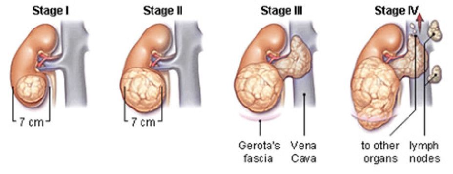 Εικ. 2 : Τα 4 στάδια του καρκίνου του νεφρού Image