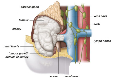 Εικ. 5: Όγκος σταδίου ΙΙΙ με επέκταση στη νεφρική φλέβα, στο περινεφρικό λίπος και στην κοίλη φλέβα Image