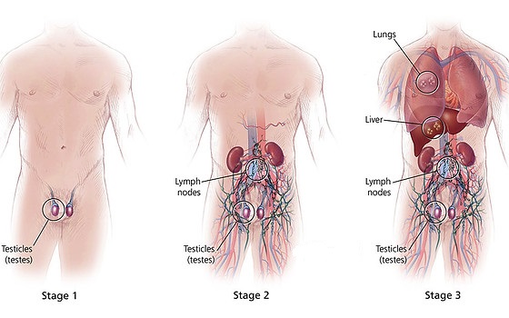 Εικ. 3: Τα Στάδια του Καρκίνου των Όρχεων Image