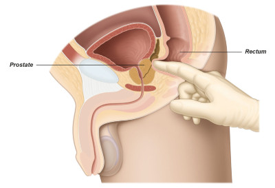 Εικ. 2: Δακτυλική Εξέταση Προστάτη Image