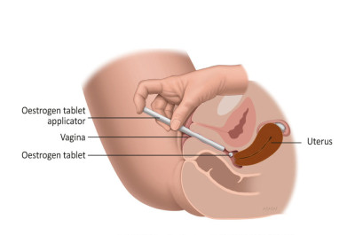 Εικ.2: Κολπικό Υπόθετο Οιστρογόνων Image