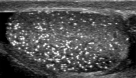 Εικ.4: Μικρολιθίαση Όρχεων Image