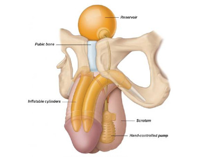 Εικ. 3: Φουσκωτό Εμφύτευμα 3 τεμαχίων Image